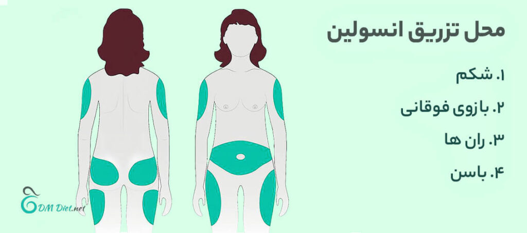 محل تزریق انسولین در بارداری