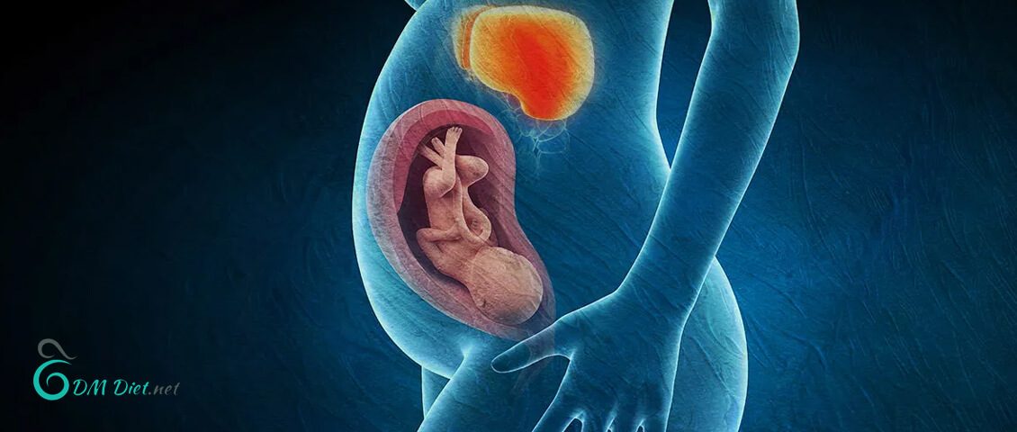 مقاله عوارض دیابت بارداری
